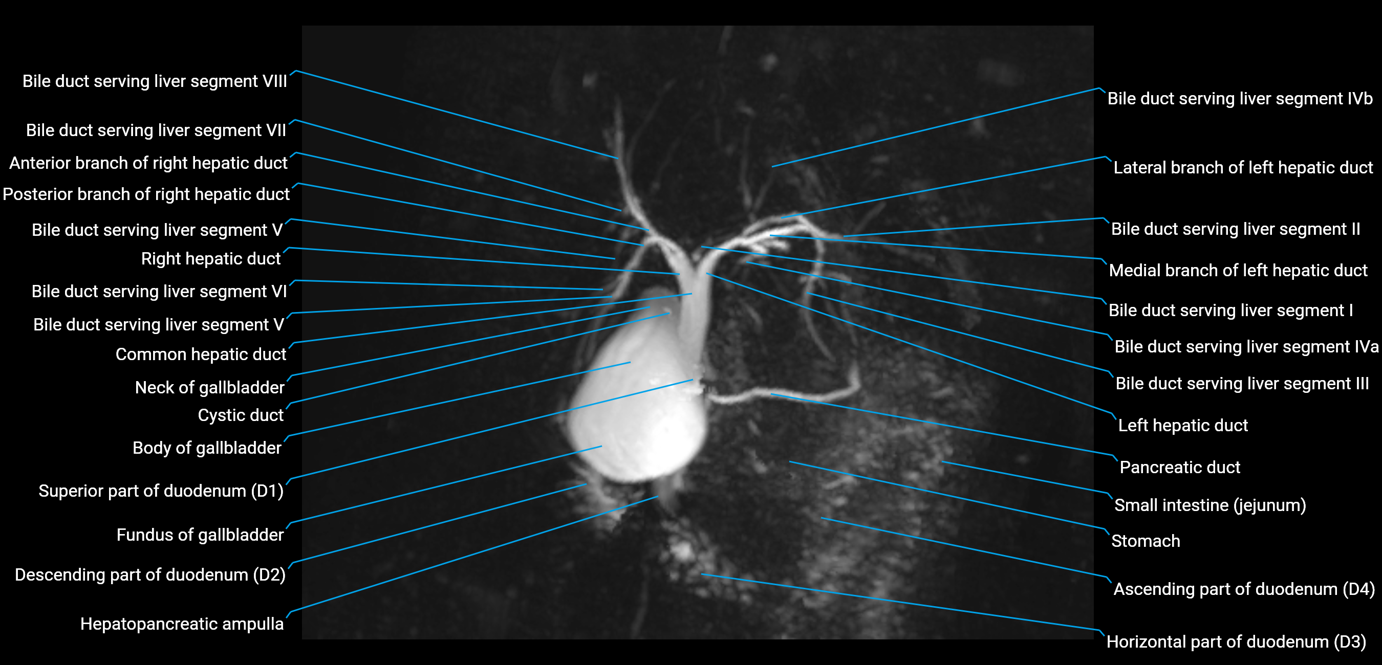 MRCP MIP MRI  anatomy labelled image-img-01003-00016.png